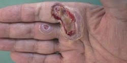 Acute wound on hand