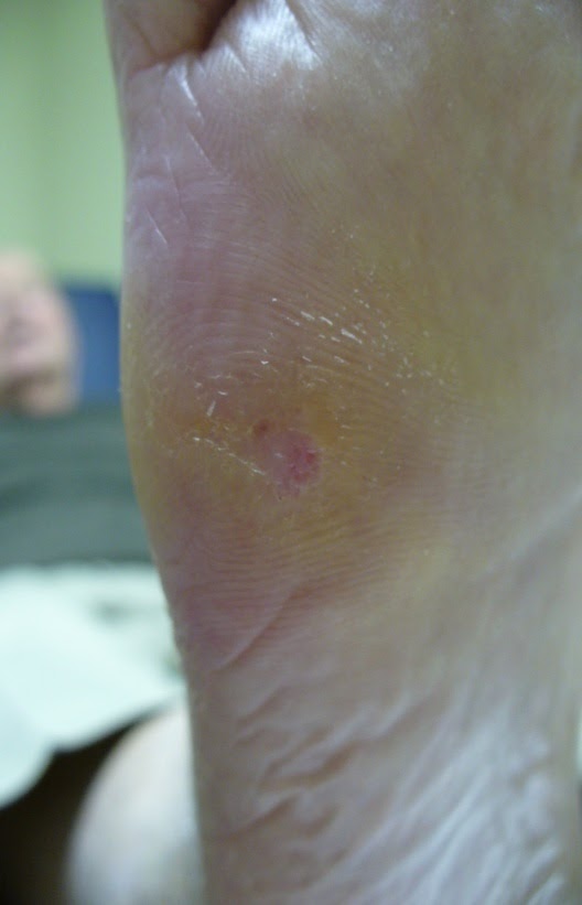 Wound after image