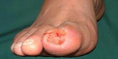 Diabetic foot ulcer on toe