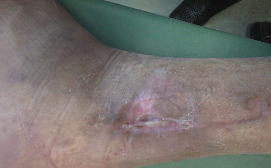 Wound after image