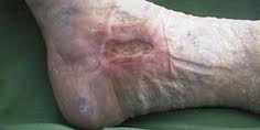 Venous ulcer on the side of foot